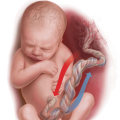 The Impact of Birth Injury on the Fetus