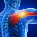 Understanding Brachial Plexus Injuries: Signs, Symptoms, and Treatment